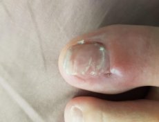 Анастасия-грибок ногтя лечение 2 года
